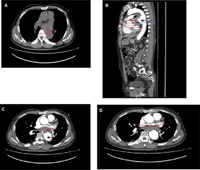 Case Report: Successful Repair of Primary Aortoesophageal Fistula With an Endovascular Stent Graft and an Esophageal Stent